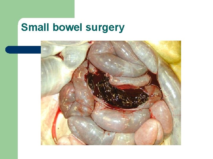 Small bowel surgery 