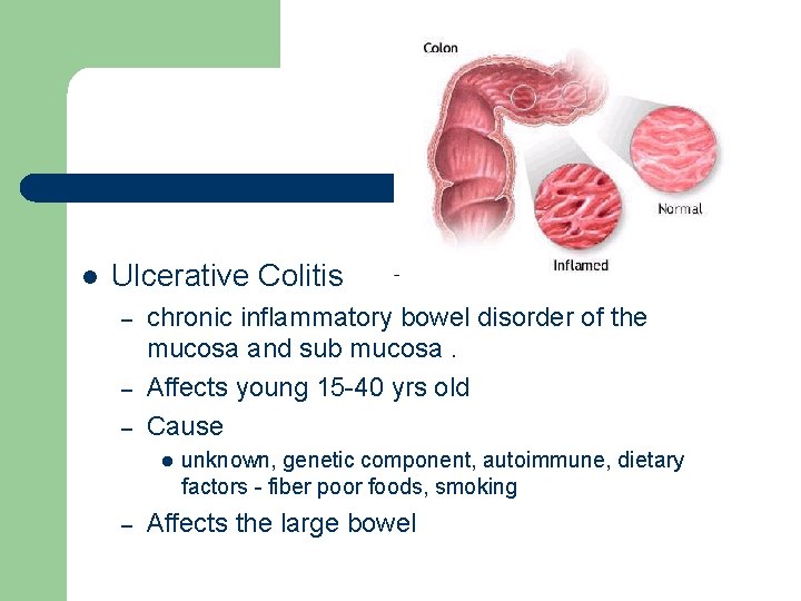 l Ulcerative Colitis – – – chronic inflammatory bowel disorder of the mucosa and