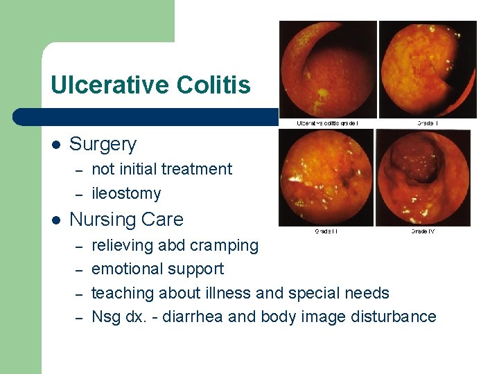 Ulcerative Colitis l Surgery – – l not initial treatment ileostomy Nursing Care –