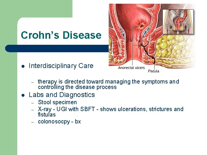 Crohn’s Disease l Interdisciplinary Care – l therapy is directed toward managing the symptoms