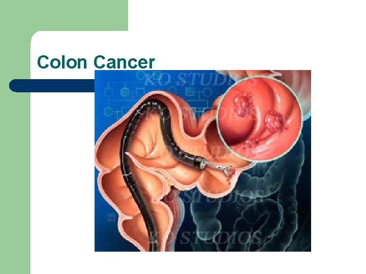 Colon Cancer 