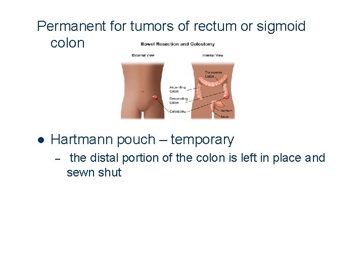 Permanent for tumors of rectum or sigmoid colon l Hartmann pouch – temporary –