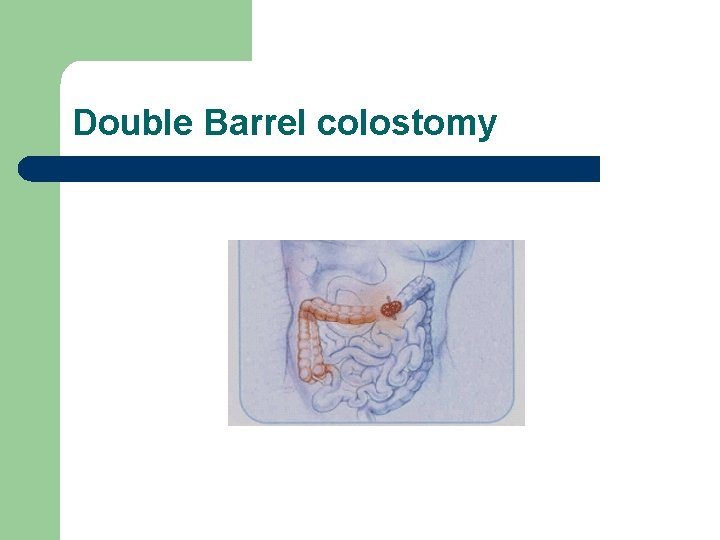 Double Barrel colostomy 