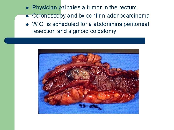 l l l Physician palpates a tumor in the rectum. Colonoscopy and bx confirm