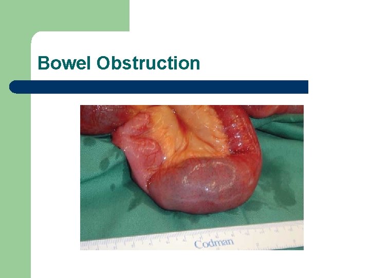 Bowel Obstruction 