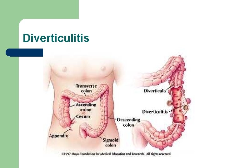 Diverticulitis 