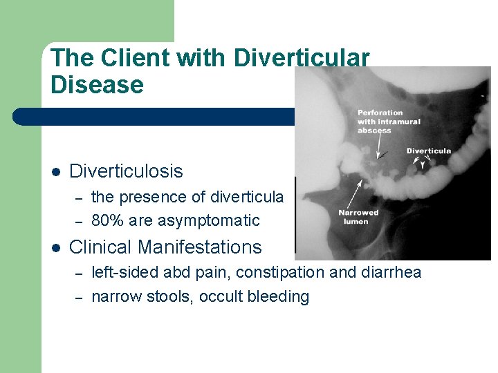 The Client with Diverticular Disease l Diverticulosis – – l the presence of diverticula