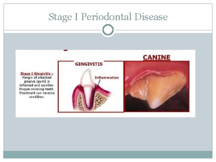Stage I Periodontal Disease 