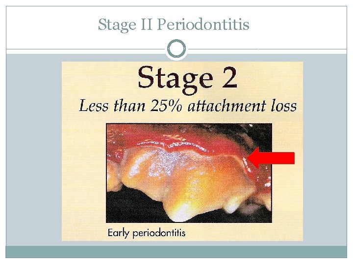 Stage II Periodontitis 