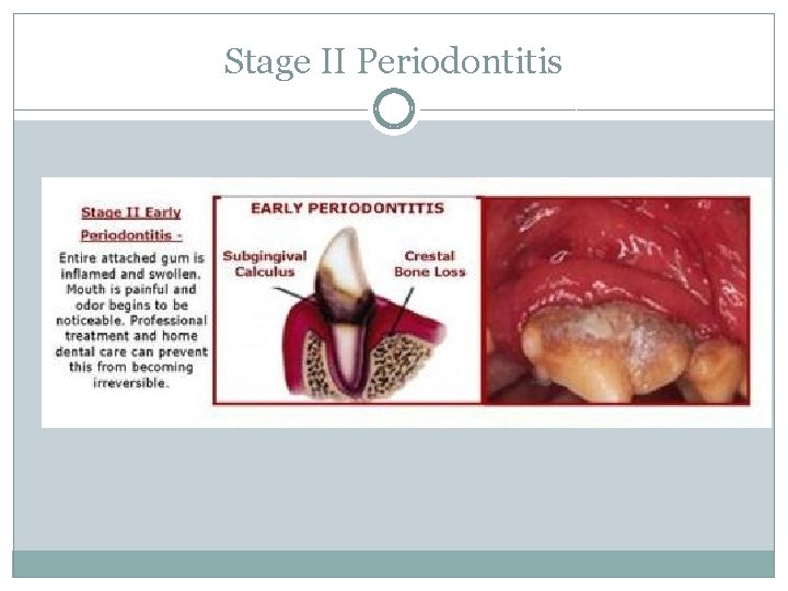 Stage II Periodontitis 