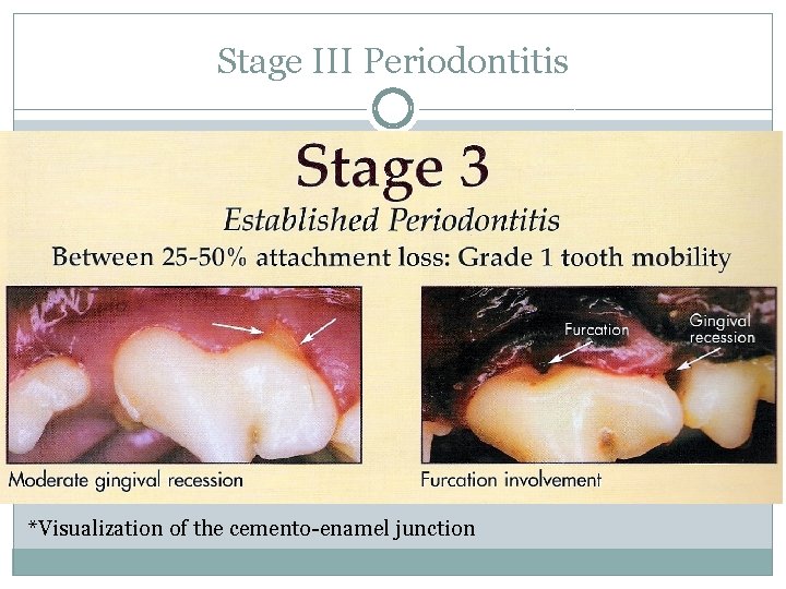 Stage III Periodontitis *Visualization of the cemento-enamel junction 