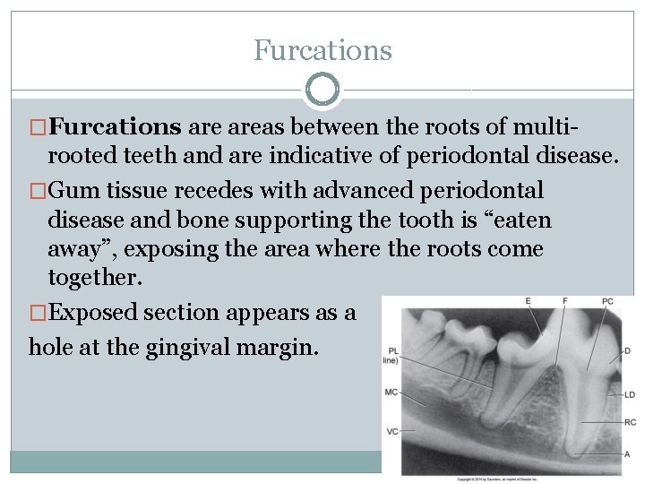 Furcations �Furcations areas between the roots of multi- rooted teeth and are indicative of