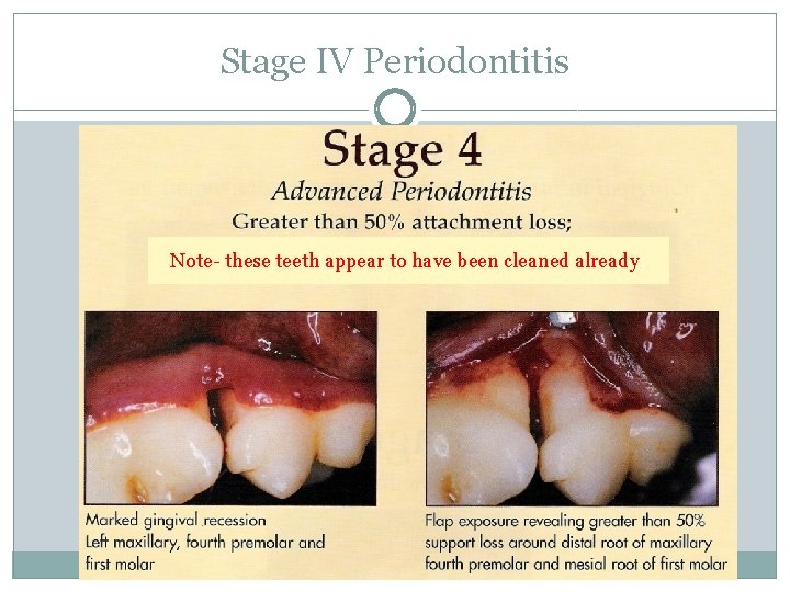 Stage IV Periodontitis Note- these teeth appear to have been cleaned already: 