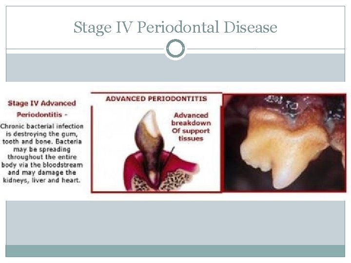 Stage IV Periodontal Disease 
