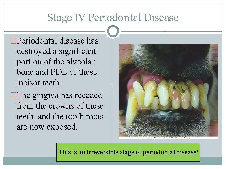 Stage IV Periodontal Disease �Periodontal disease has destroyed a significant portion of the alveolar