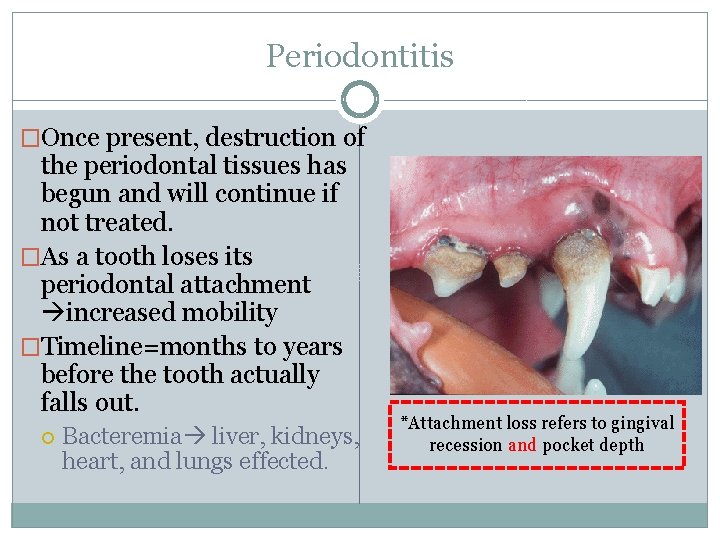 Periodontitis �Once present, destruction of the periodontal tissues has begun and will continue if