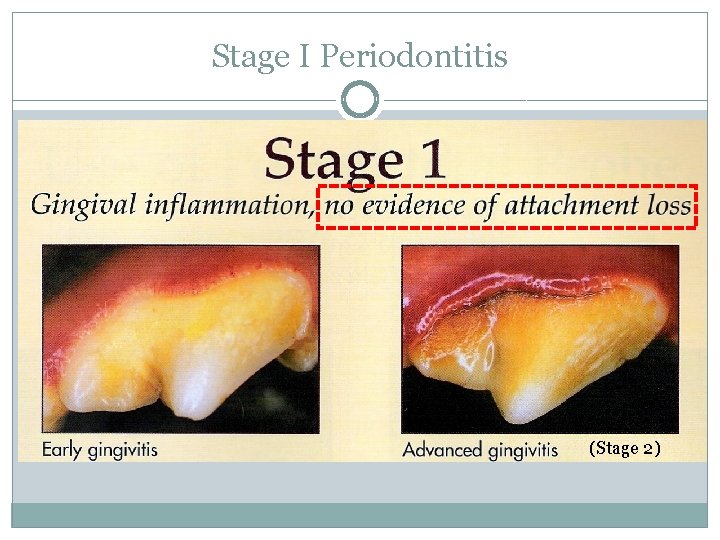 Stage I Periodontitis (Stage 2) 