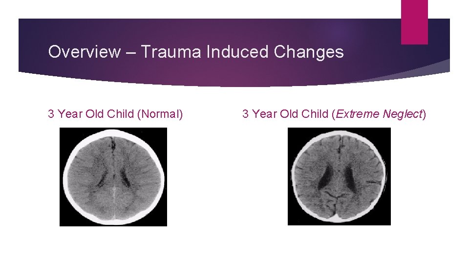 Overview – Trauma Induced Changes 3 Year Old Child (Normal) 3 Year Old Child