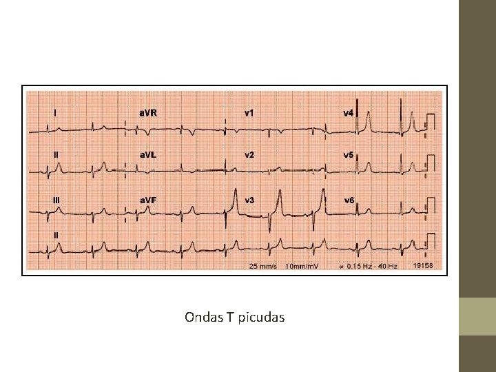 Ondas T picudas 