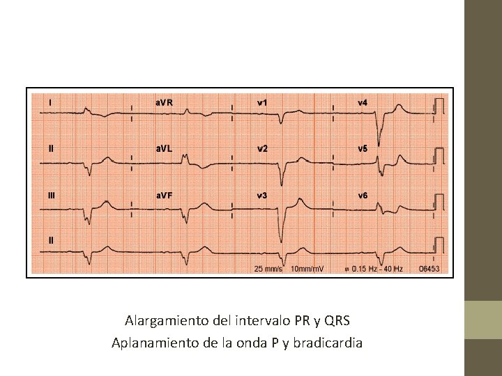 Alargamiento del intervalo PR y QRS Aplanamiento de la onda P y bradicardia 