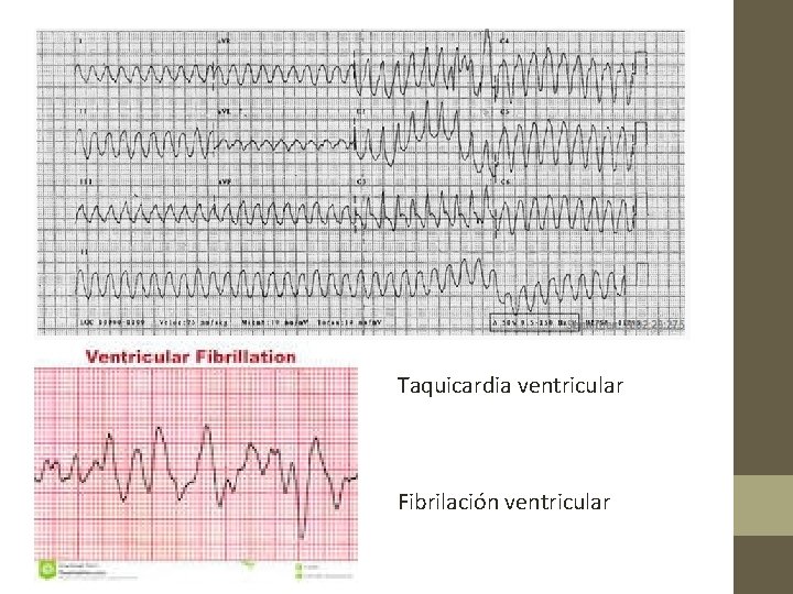 Taquicardia ventricular Fibrilación ventricular 