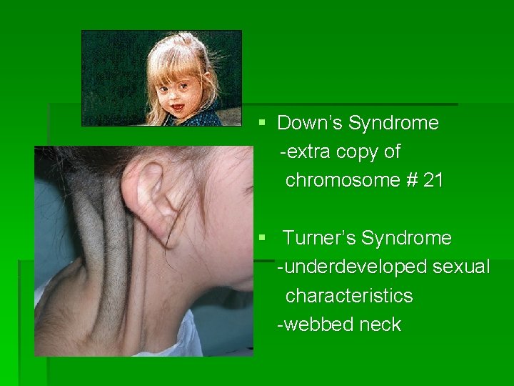 § Down’s Syndrome -extra copy of chromosome # 21 § Turner’s Syndrome -underdeveloped sexual