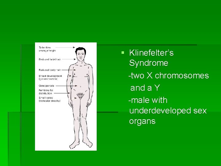 § Klinefelter’s Syndrome -two X chromosomes and a Y -male with underdeveloped sex organs