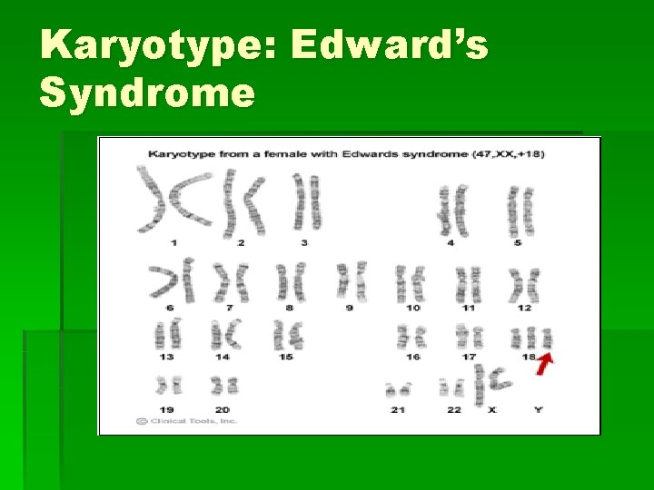 Karyotype: Edward’s Syndrome 