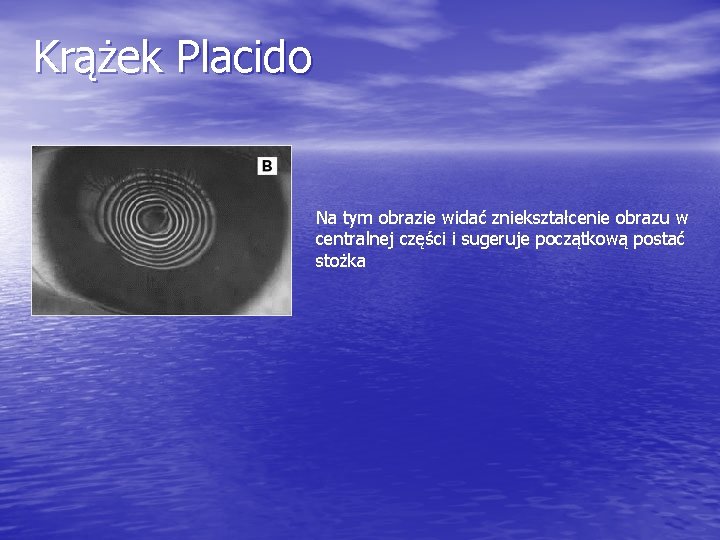 Krążek Placido Na tym obrazie widać zniekształcenie obrazu w centralnej części i sugeruje początkową