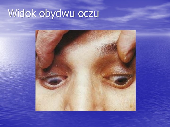 Widok obydwu oczu 