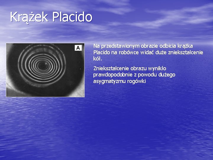Krążek Placido Na przedstawionym obrazie odbicia krążka Placido na robówce widać duże zniekształcenie kół.