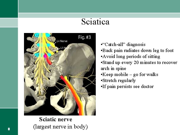 Sciatica • “Catch-all” diagnosis • Back pain radiates down leg to foot • Avoid