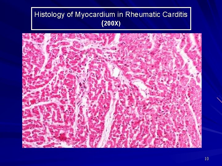 Histology of Myocardium in Rheumatic Carditis (200 X) 10 