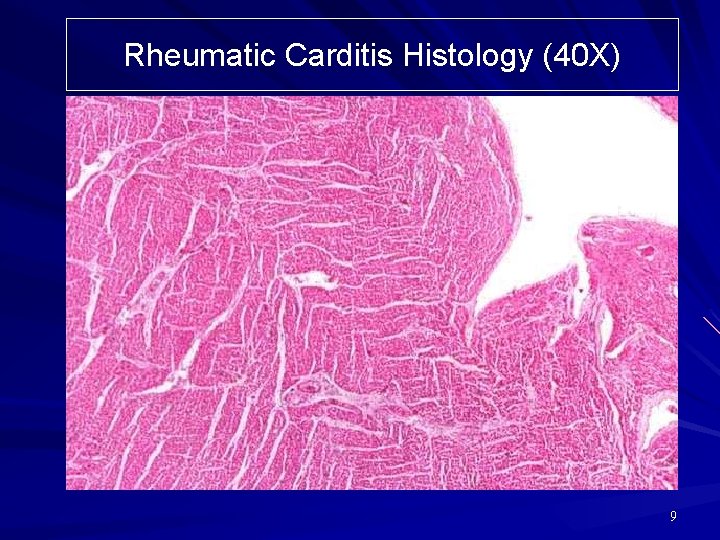 Rheumatic Carditis Histology (40 X) 9 