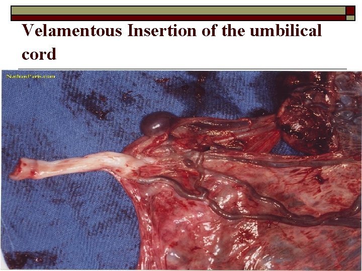 Velamentous Insertion of the umbilical cord 