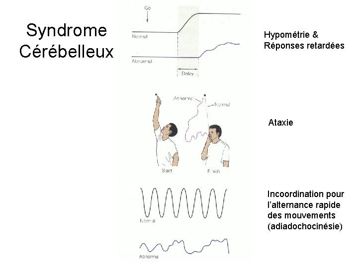 Syndrome Cérébelleux Hypométrie & Réponses retardées Ataxie Incoordination pour l’alternance rapide des mouvements (adiadochocinésie) Syndrome Cérébelleux Hypométrie & Réponses retardées Ataxie Incoordination pour l’alternance rapide des mouvements (adiadochocinésie)