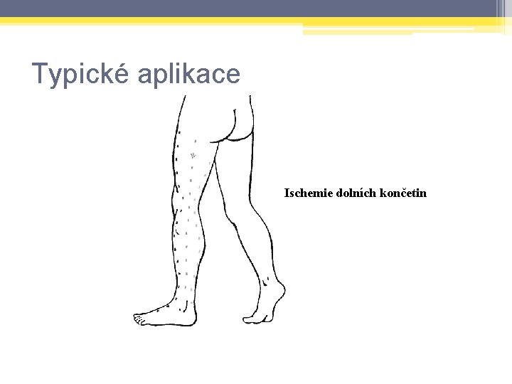 Typické aplikace Ischemie dolních končetin 