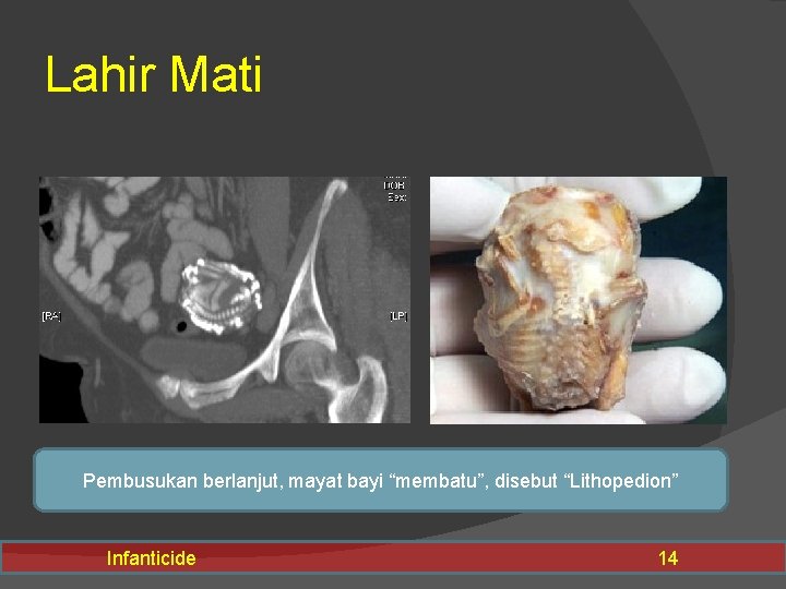 Lahir Mati Pembusukan berlanjut, mayat bayi “membatu”, disebut “Lithopedion” Infanticide 14 