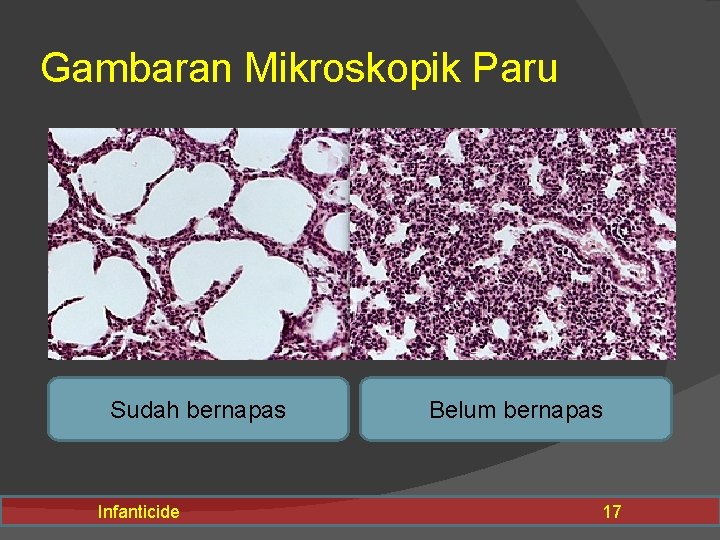 Gambaran Mikroskopik Paru Sudah bernapas Infanticide Belum bernapas 17 