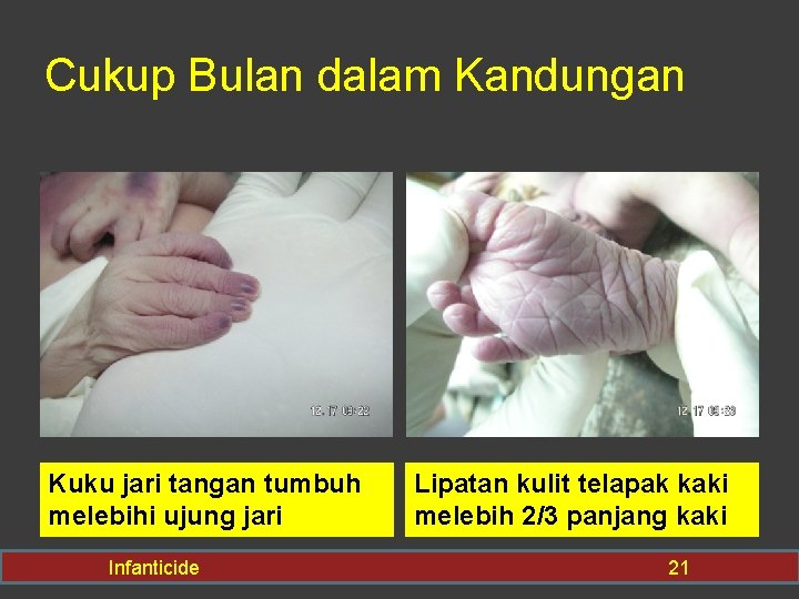 Cukup Bulan dalam Kandungan Kuku jari tangan tumbuh melebihi ujung jari Infanticide Lipatan kulit