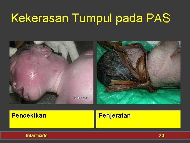 Kekerasan Tumpul pada PAS Pencekikan Infanticide Penjeratan 30 