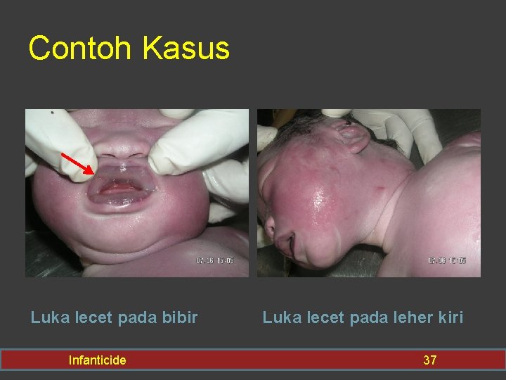 Contoh Kasus Luka lecet pada bibir Infanticide Luka lecet pada leher kiri 37 