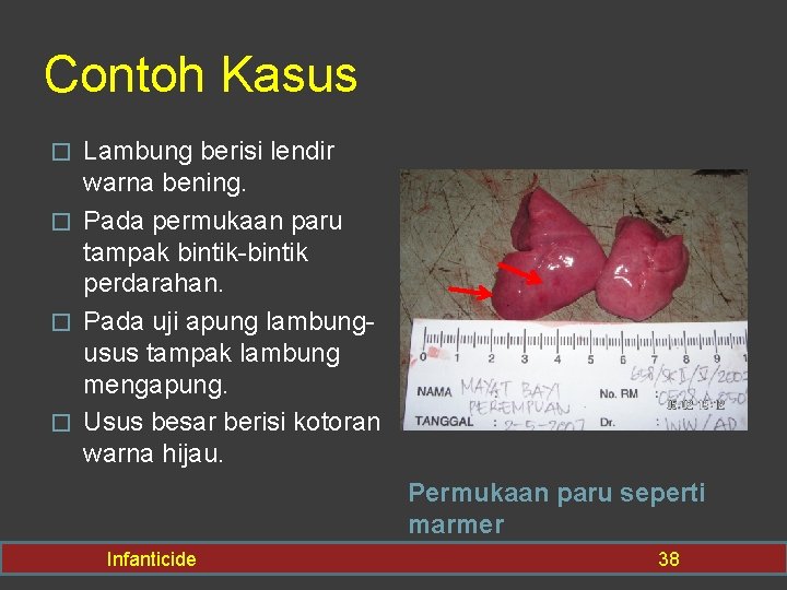 Contoh Kasus Lambung berisi lendir warna bening. � Pada permukaan paru tampak bintik-bintik perdarahan.