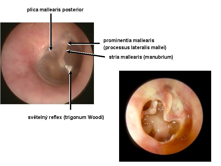 plica mallearis posterior prominentia mallearis (processus lateralis mallei) stria mallearis (manubrium) světelný reflex (trigonum