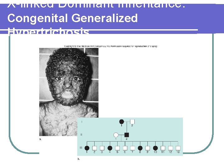 X-linked Dominant Inheritance: Congenital Generalized Hypertrichosis Figure 6. 10 