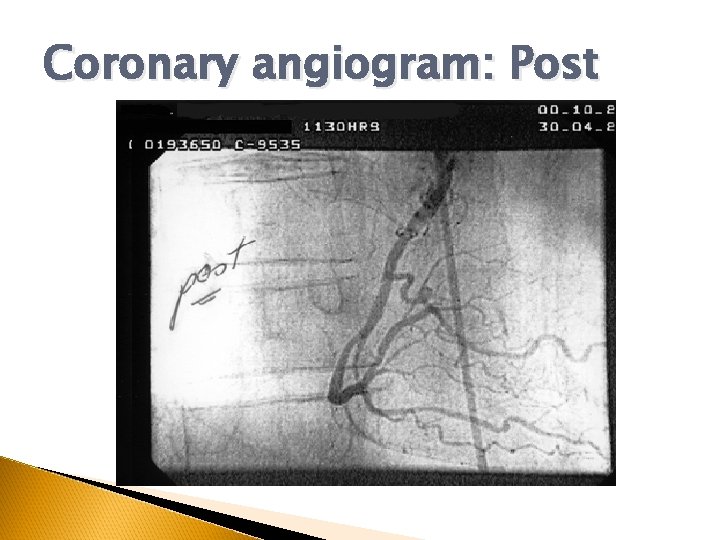 Coronary angiogram: Post 