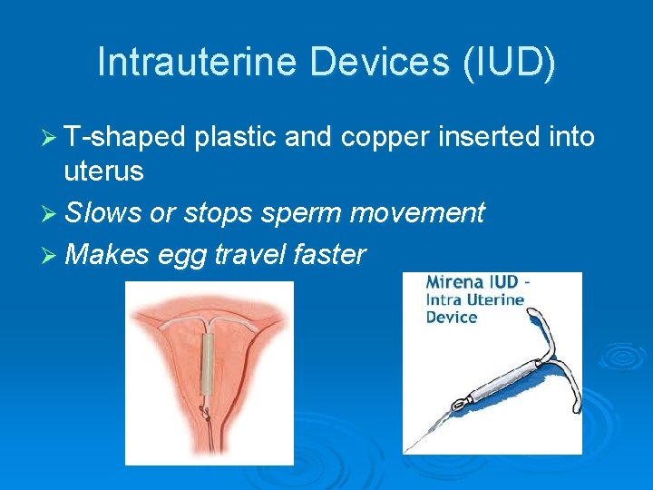 Intrauterine Devices (IUD) Ø T-shaped plastic and copper inserted into uterus Ø Slows or
