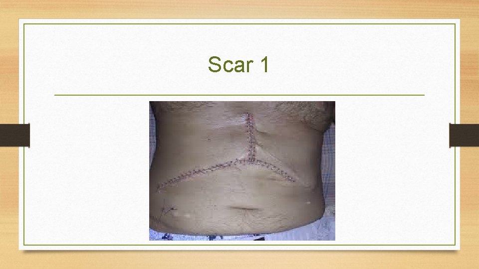 Scar 1 