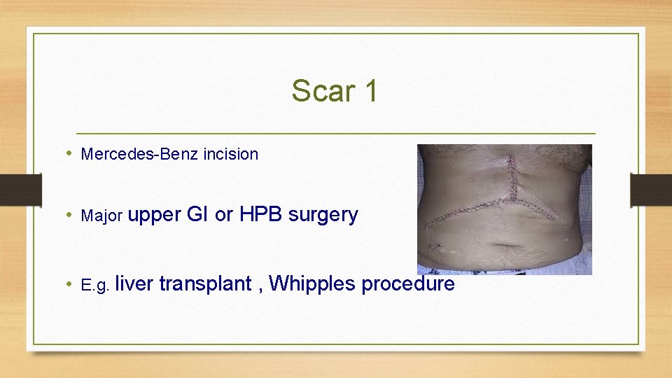 Scar 1 • Mercedes-Benz incision • Major upper GI or HPB surgery • E.