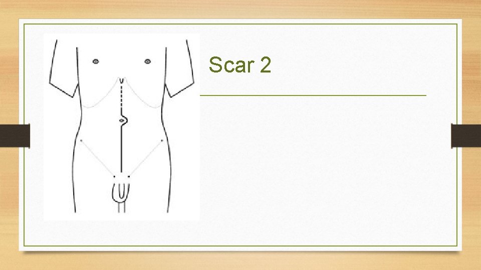 Scar 2 